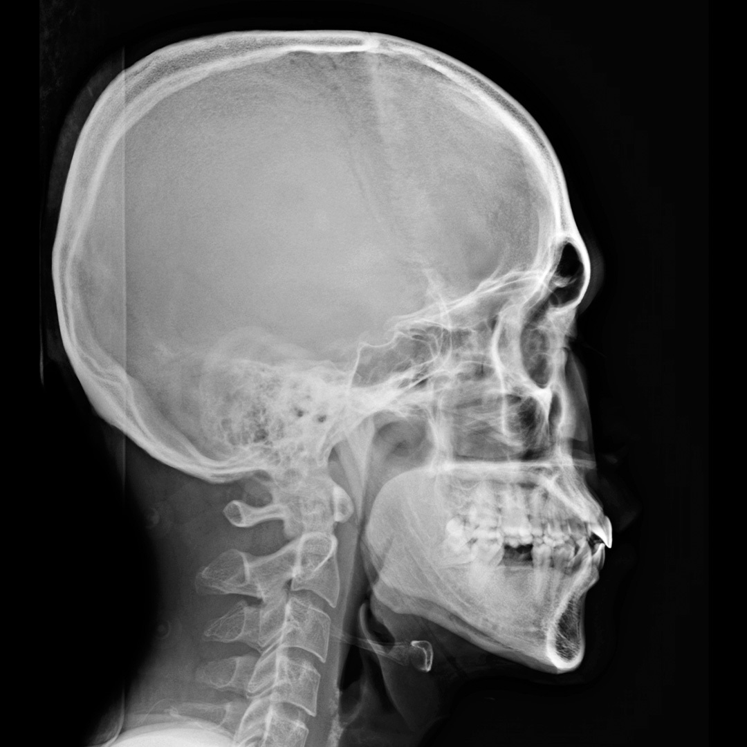 Un crâne aux rayons X, de face et de profil.