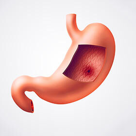 Stress is the primary cause of stomach ulcers.