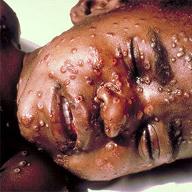 In 1999, there were 800,000 victims of smallpox in the world.