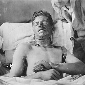 Mustard gas slowly kills its victims, usually in four or five weeks.