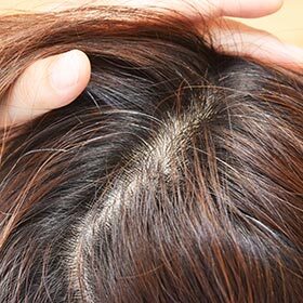 Chaque follicule pileux produit environ 5 cheveux durant la vie d’une personne.