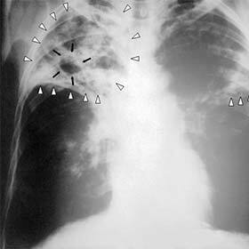 Tuberculosis, one of the biggest killers in history, was officially eradicated in 2008.